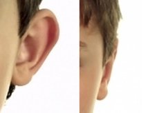 plastika uší před a po