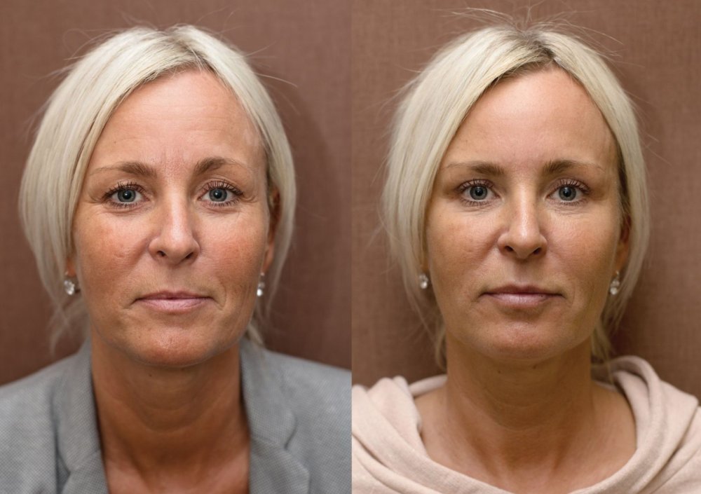 Anti-aging proměny: Plazmaterapie, injekční výplně, operace očních víček