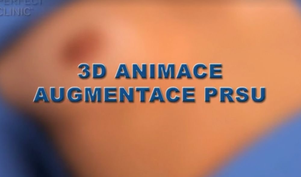 3D animation breast augmentation - step by step