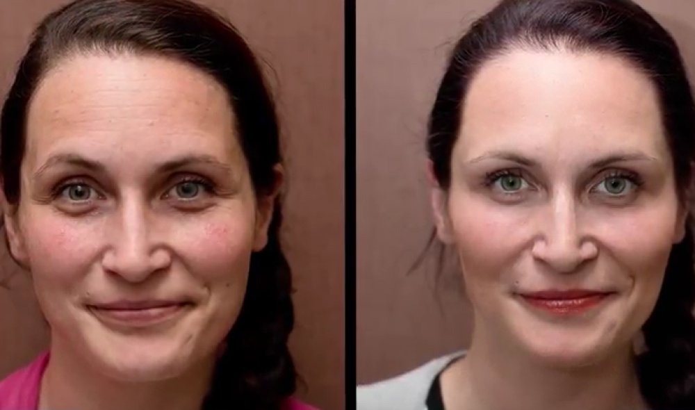 Anti-aging transformations: Plasma therapy and circles under the eyes