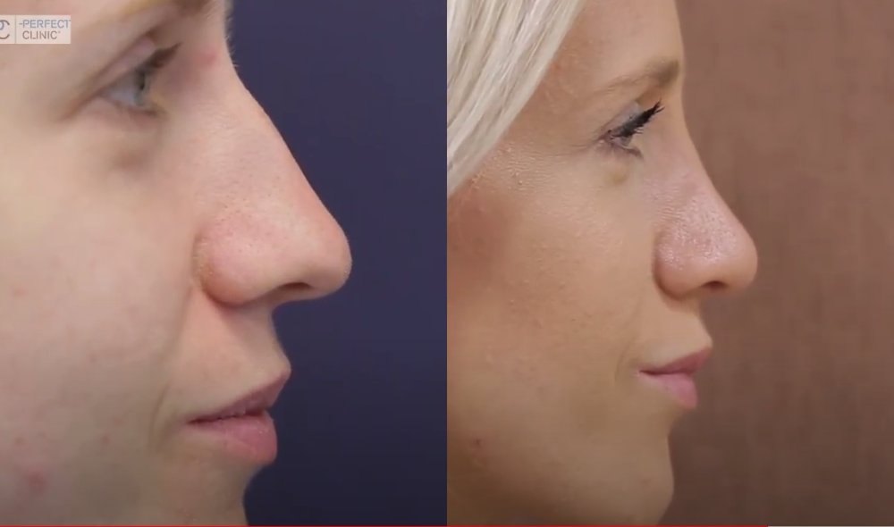 Otevřená metoda operace nosu