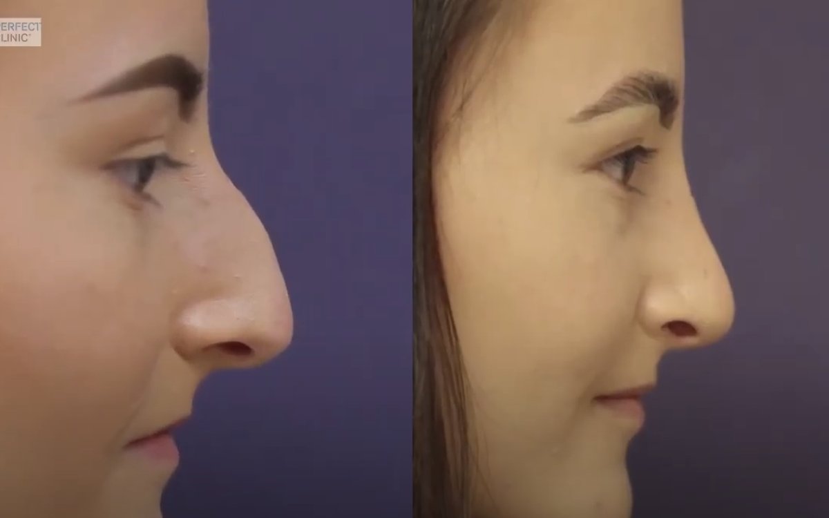 Nové video: Operace nosu a nosní přepážky v jedné době
