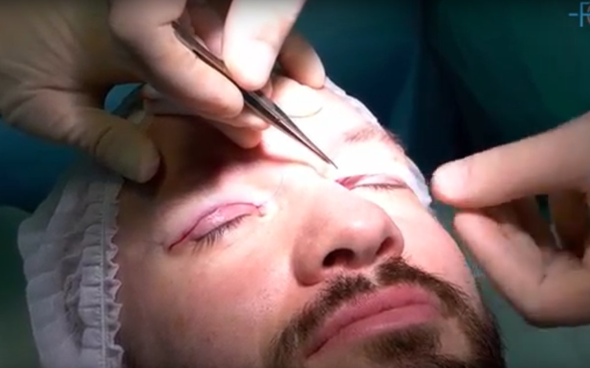 Operace očních víček u mužů