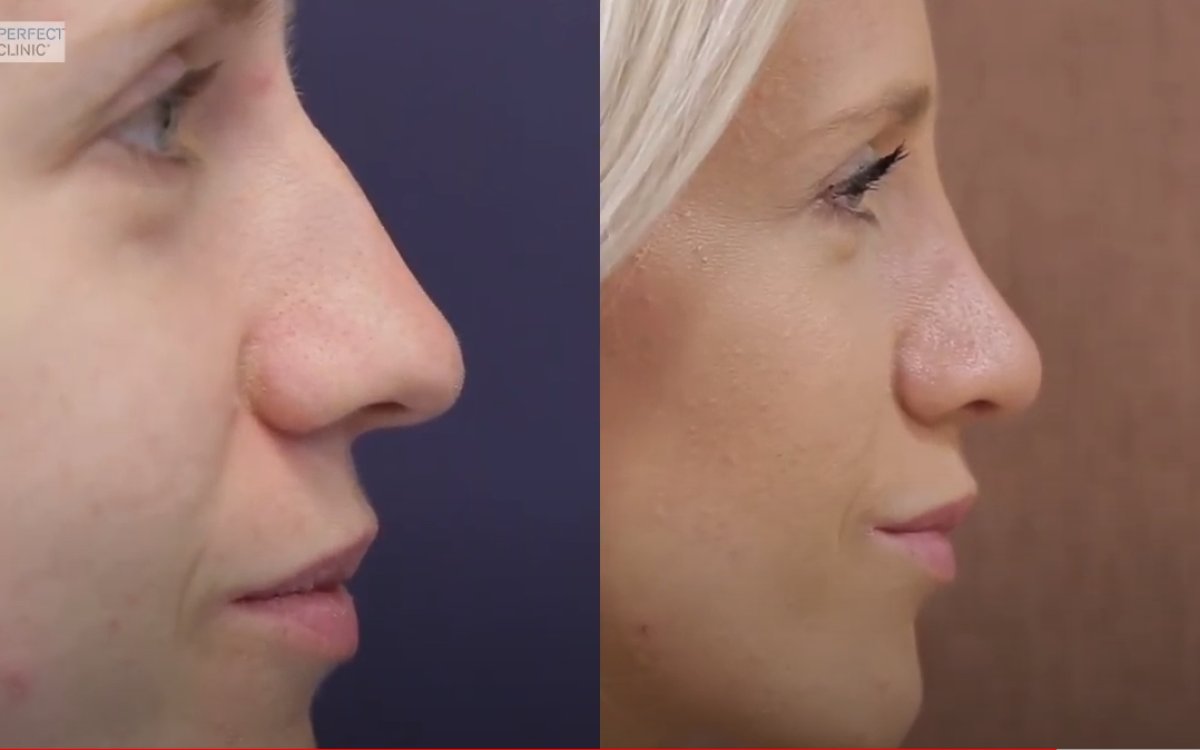 Otevřená metoda operace nosu